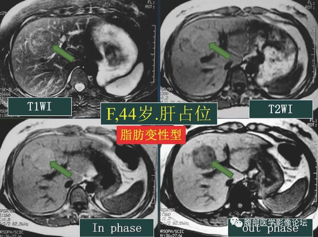影像PPT - 【PPT】肝脏常见富血供病变读片-64