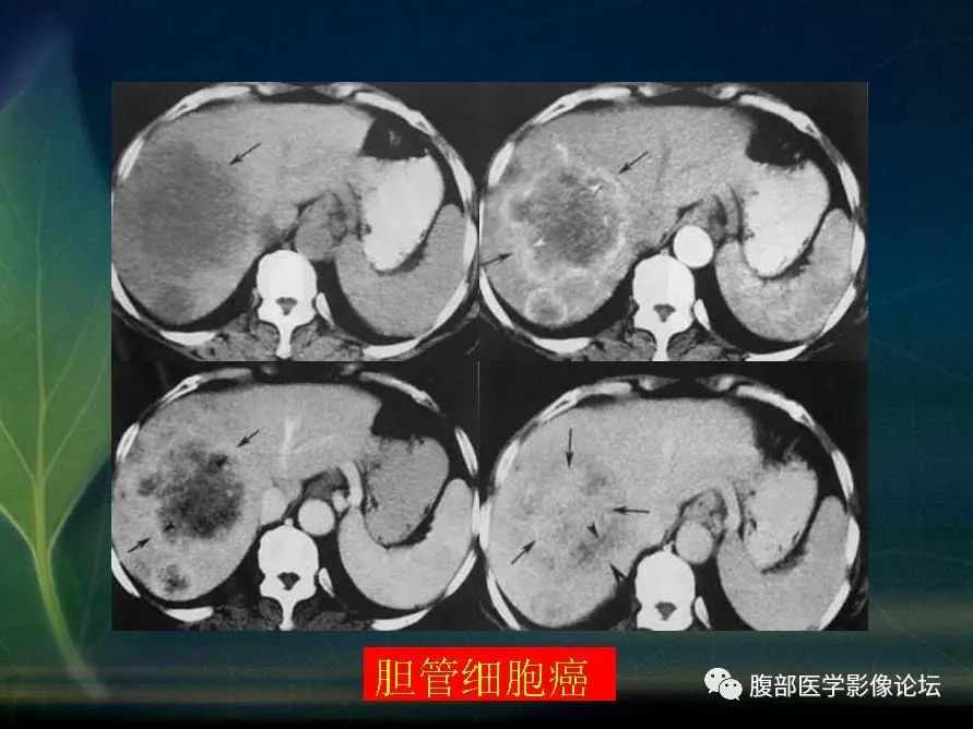 影像PPT - 【PPT】肝脏常见富血供病变读片-67