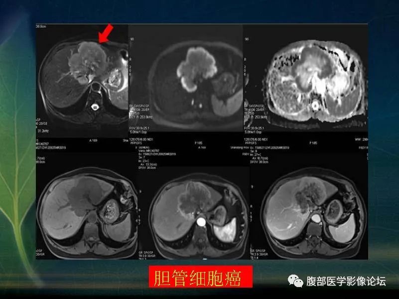 影像PPT - 【PPT】肝脏常见富血供病变读片-68