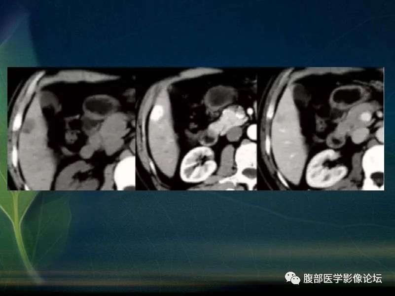 影像PPT - 【PPT】肝脏常见富血供病变读片-78