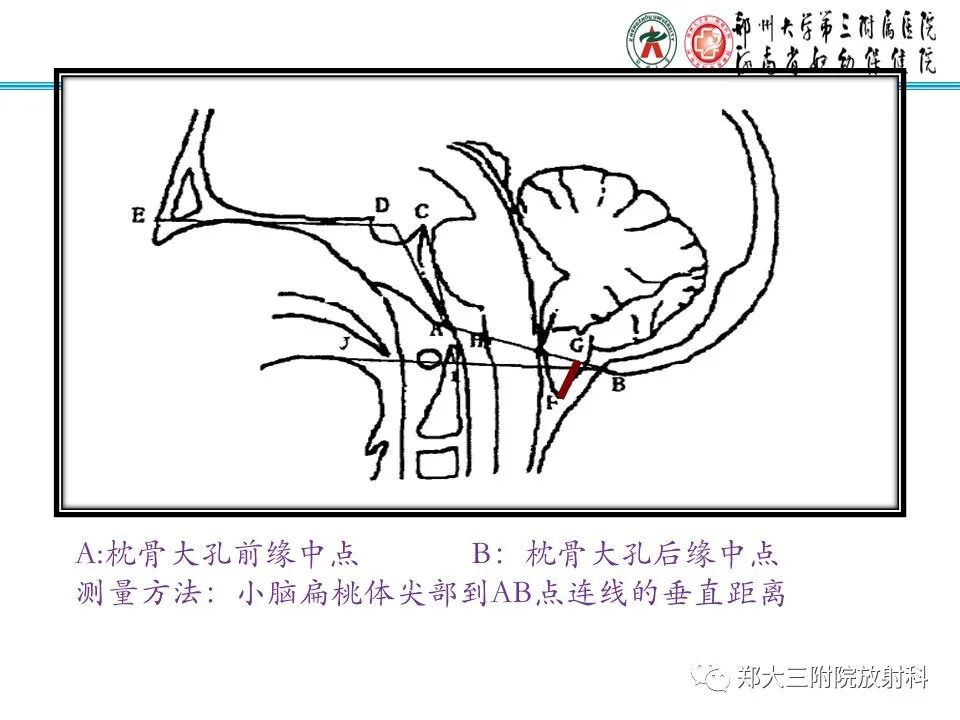 影像PPT - 【PPT】 Chiari畸形的影像诊断-13