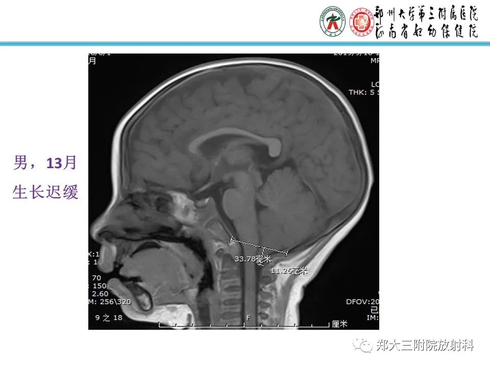 影像PPT - 【PPT】 Chiari畸形的影像诊断-16