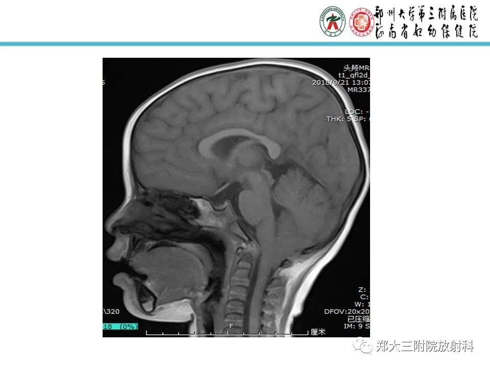 影像PPT - 【PPT】 Chiari畸形的影像诊断-18