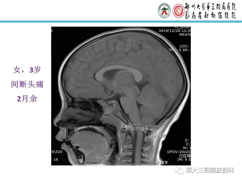影像PPT - 【PPT】 Chiari畸形的影像诊断-17