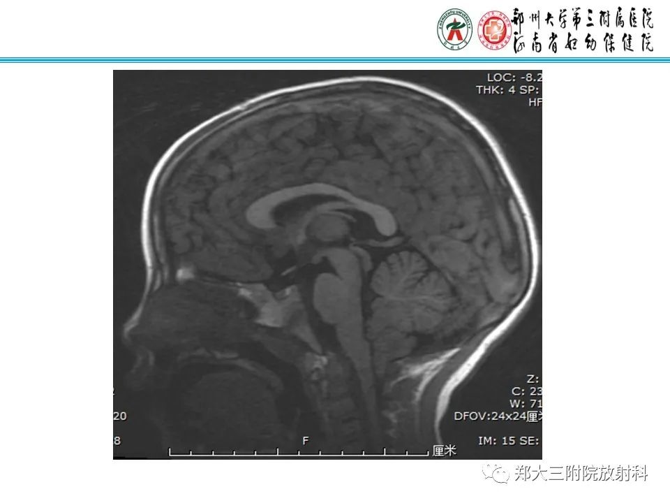 影像PPT - 【PPT】 Chiari畸形的影像诊断-19