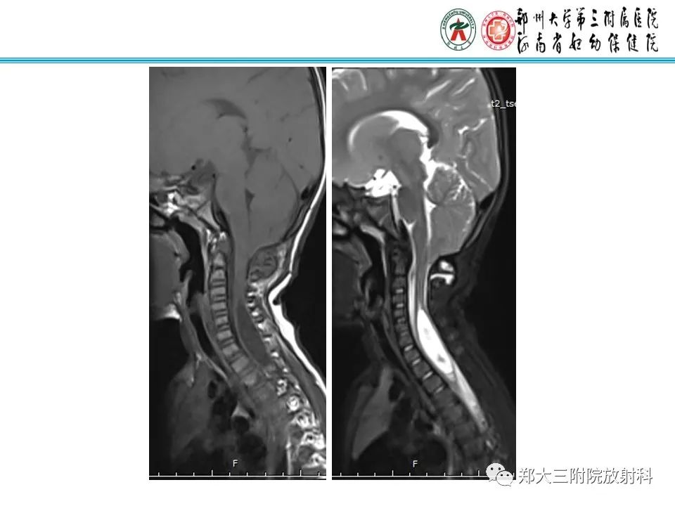 影像PPT - 【PPT】 Chiari畸形的影像诊断-21