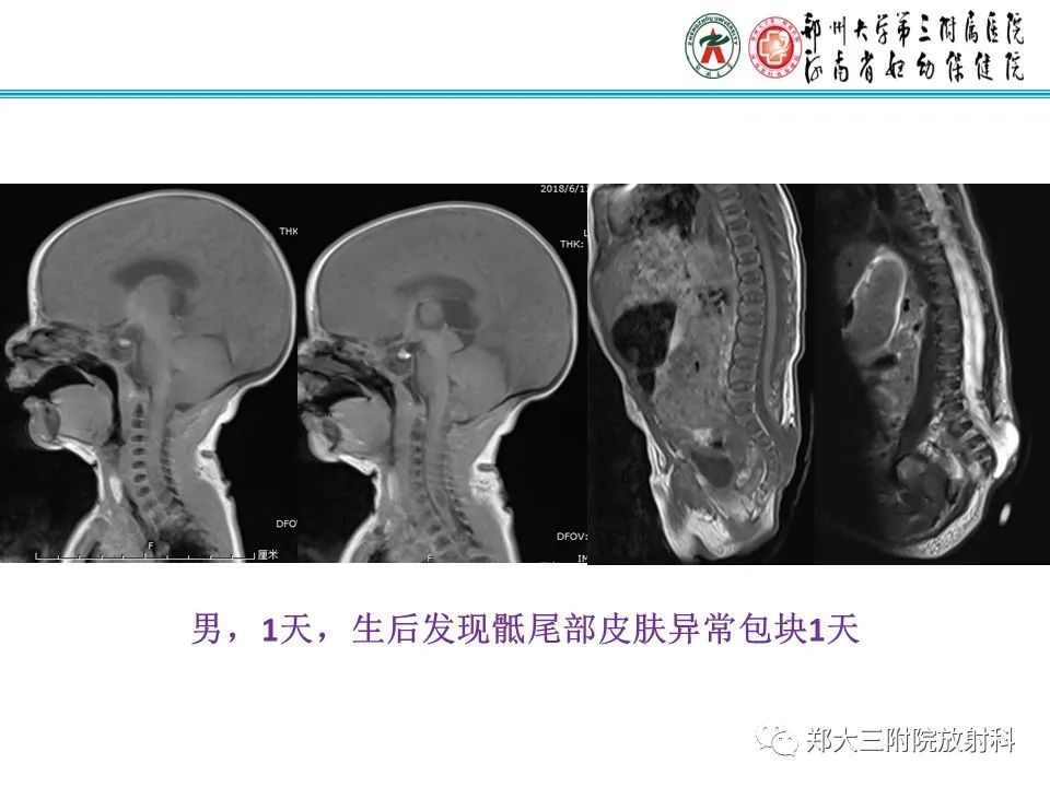 影像PPT - 【PPT】 Chiari畸形的影像诊断-23