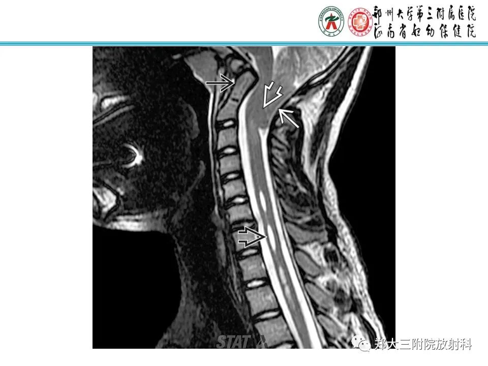 影像PPT - 【PPT】 Chiari畸形的影像诊断-22