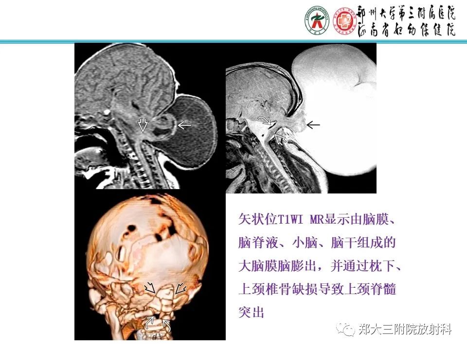 影像PPT - 【PPT】 Chiari畸形的影像诊断-25