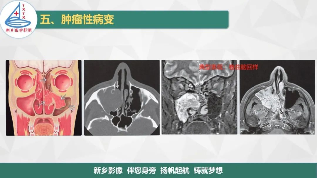 影像PPT - 【PPT】医学影像诊断学教材解读—鼻部疾病2-5
