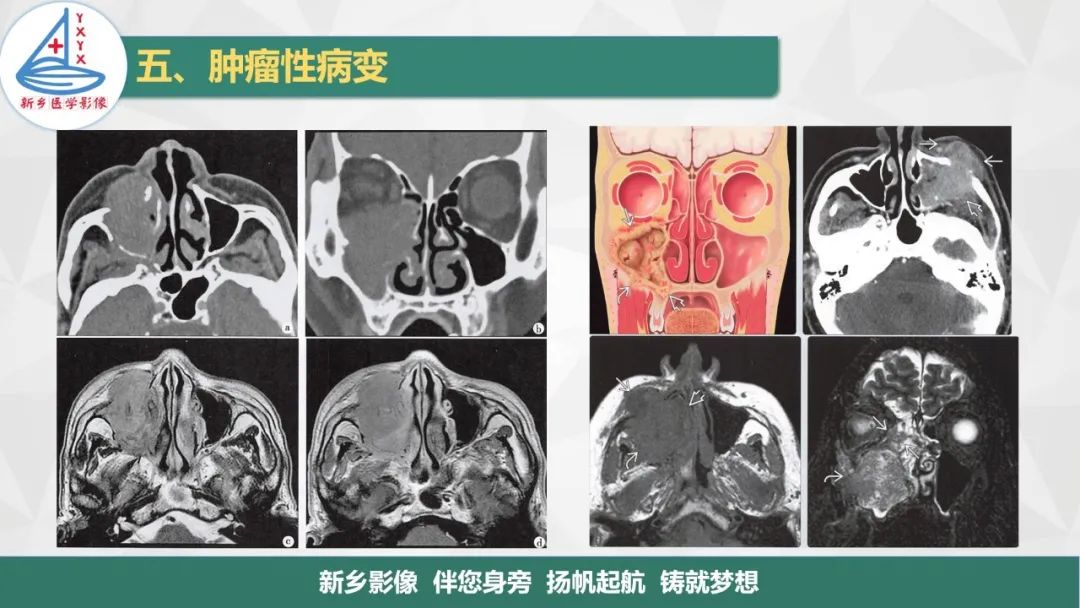 影像PPT - 【PPT】医学影像诊断学教材解读—鼻部疾病2-9