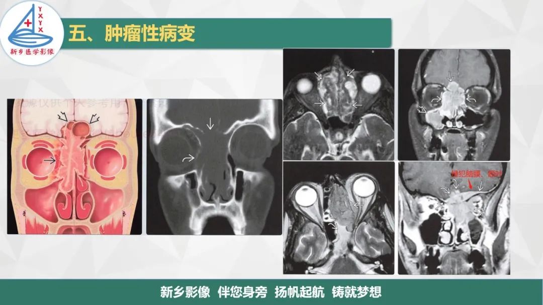 影像PPT - 【PPT】医学影像诊断学教材解读—鼻部疾病2-12