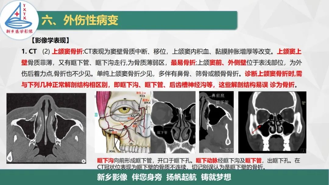 影像PPT - 【PPT】医学影像诊断学教材解读—鼻部疾病2-15