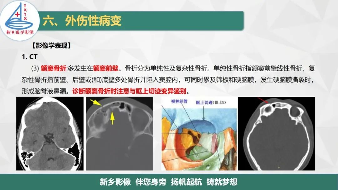 影像PPT - 【PPT】医学影像诊断学教材解读—鼻部疾病2-16