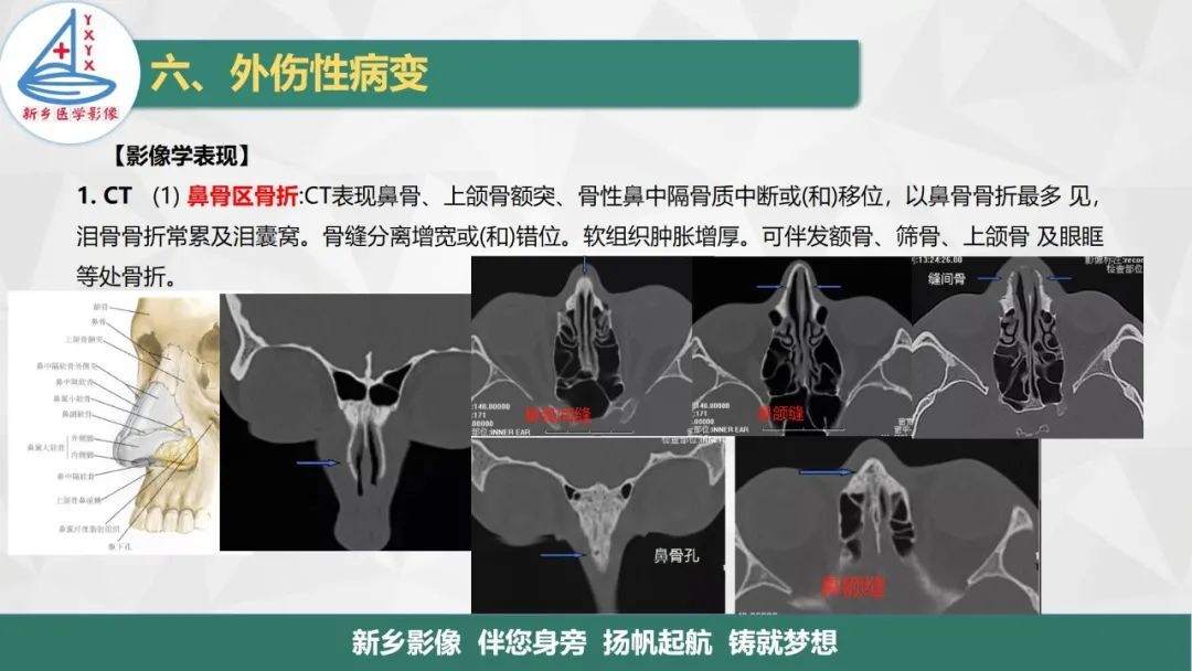 影像PPT - 【PPT】医学影像诊断学教材解读—鼻部疾病2-14