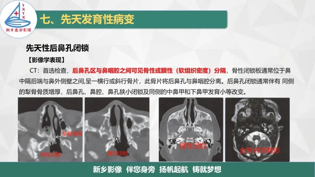 影像PPT - 【PPT】医学影像诊断学教材解读—鼻部疾病2-20