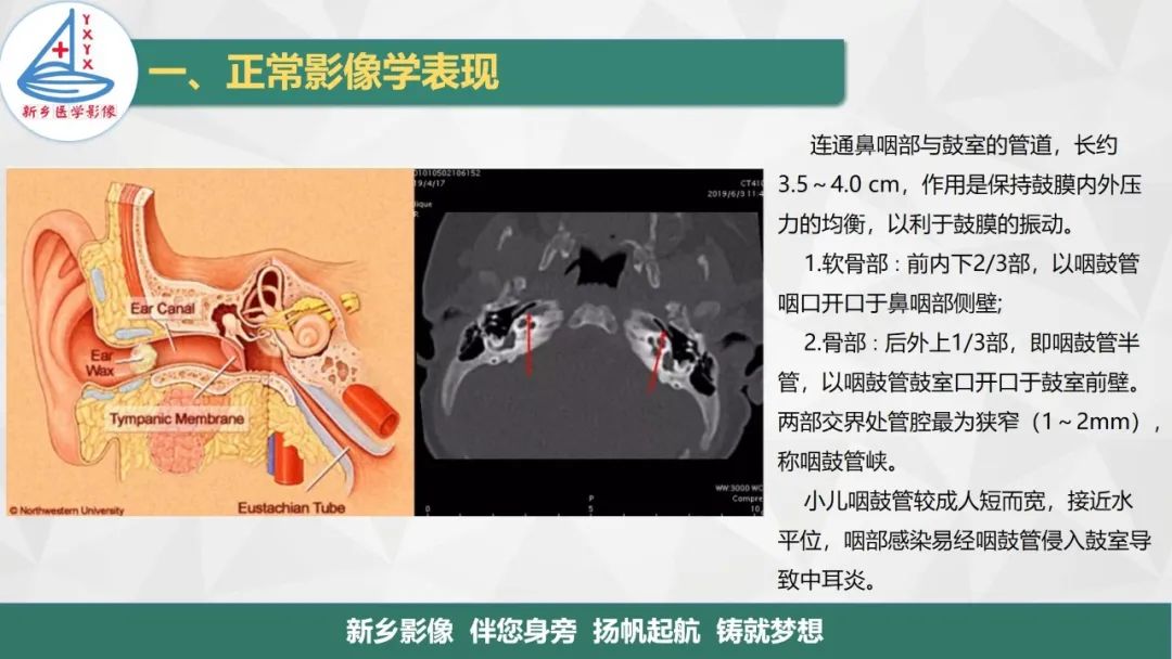 影像PPT - 【PPT】医学影像诊断学教材解读—耳部疾病-6