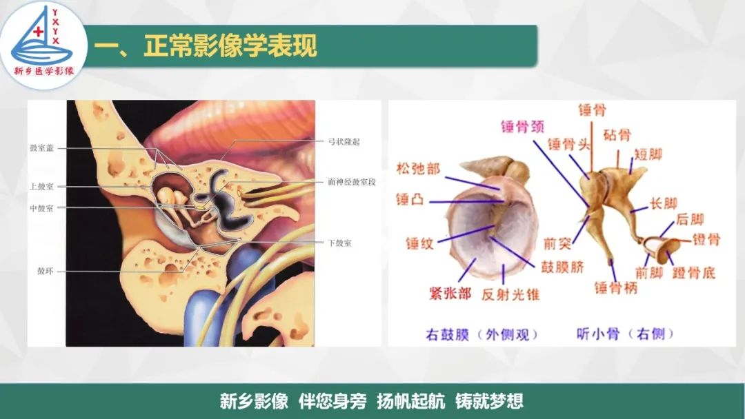 影像PPT - 【PPT】医学影像诊断学教材解读—耳部疾病-4