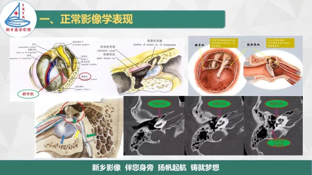 影像PPT - 【PPT】医学影像诊断学教材解读—耳部疾病-5
