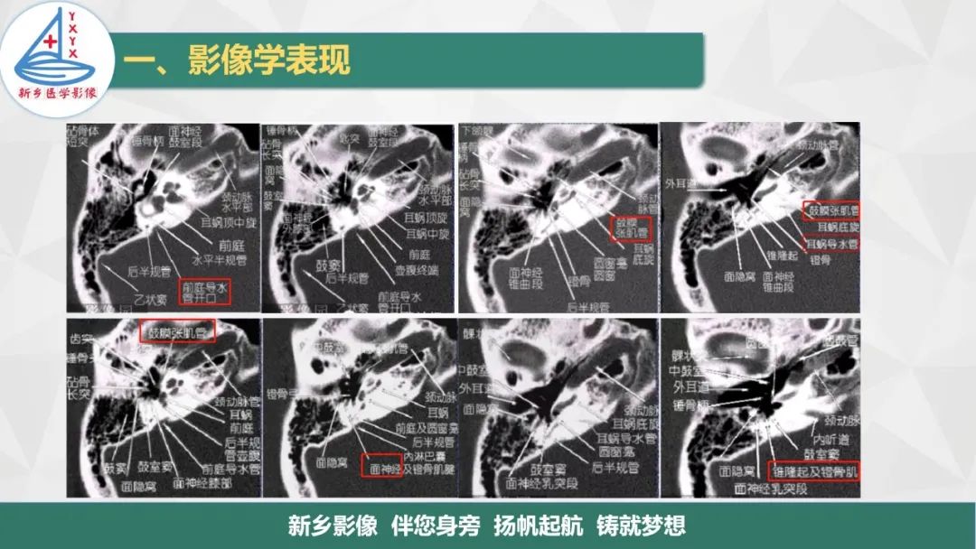 影像PPT - 【PPT】医学影像诊断学教材解读—耳部疾病-10