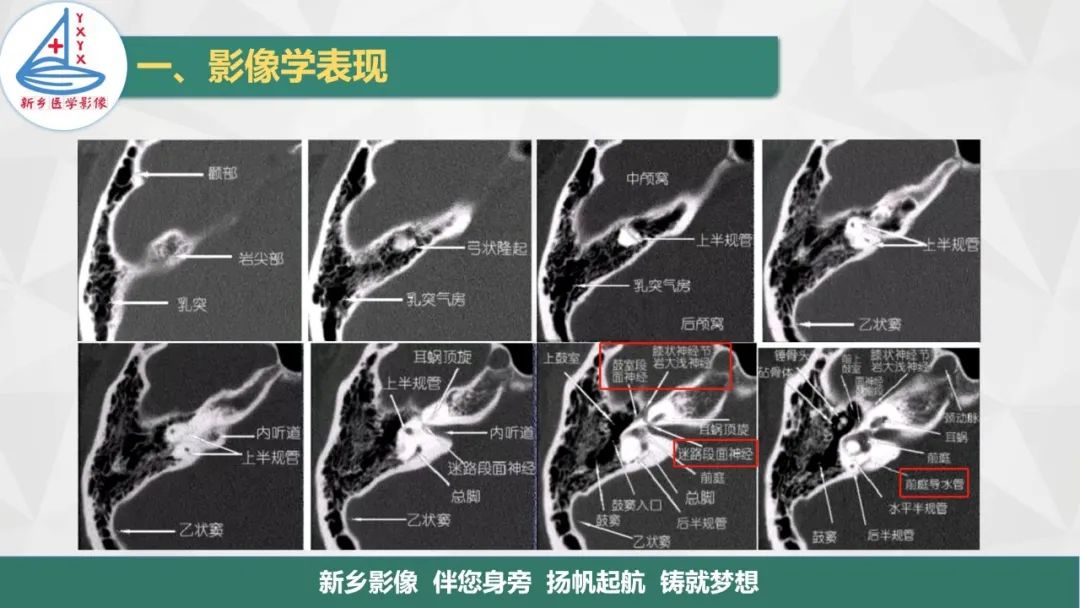 影像PPT - 【PPT】医学影像诊断学教材解读—耳部疾病-9