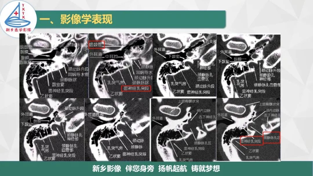 影像PPT - 【PPT】医学影像诊断学教材解读—耳部疾病-11