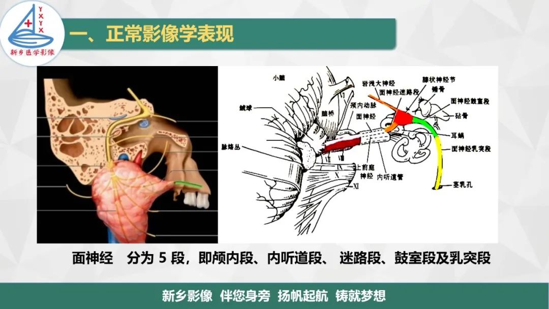 影像PPT - 【PPT】医学影像诊断学教材解读—耳部疾病-8