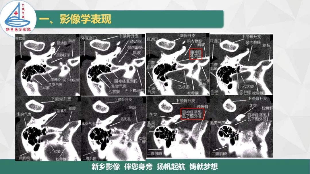 影像PPT - 【PPT】医学影像诊断学教材解读—耳部疾病-12