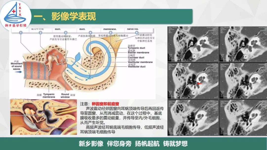 影像PPT - 【PPT】医学影像诊断学教材解读—耳部疾病-13