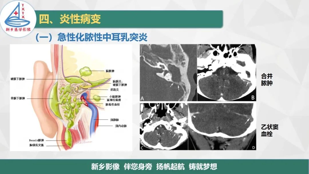 影像PPT - 【PPT】医学影像诊断学教材解读—耳部疾病-23