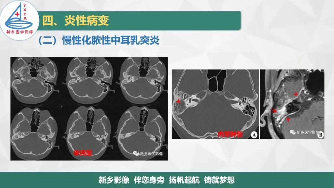 影像PPT - 【PPT】医学影像诊断学教材解读—耳部疾病-26