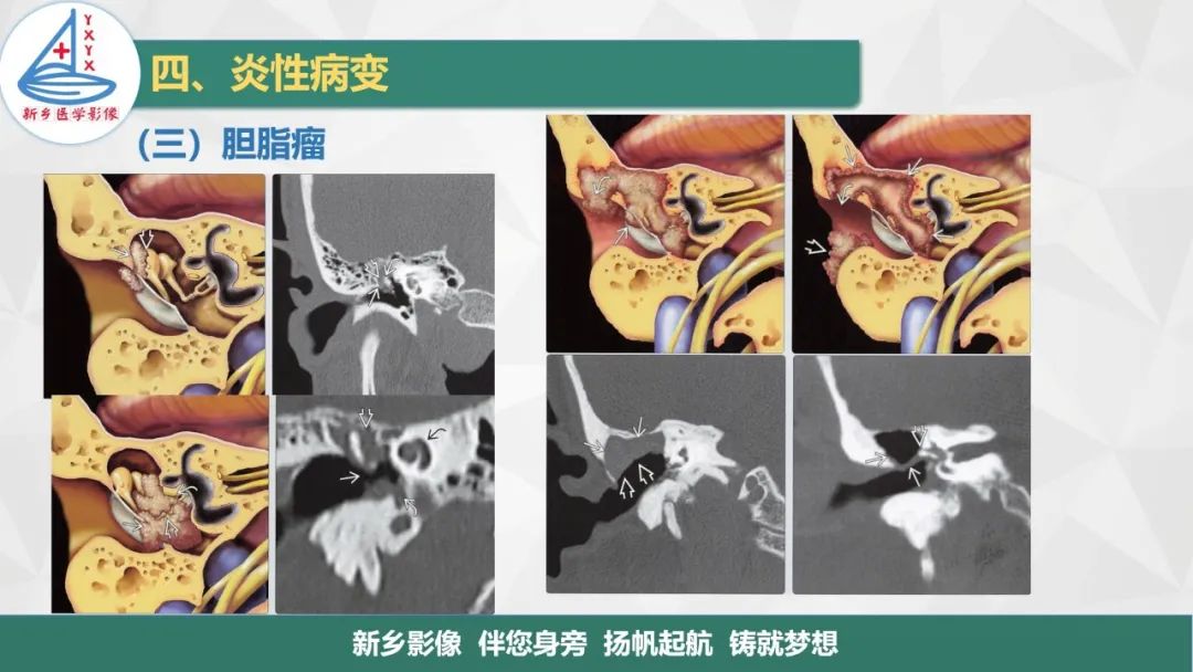 影像PPT - 【PPT】医学影像诊断学教材解读—耳部疾病-29