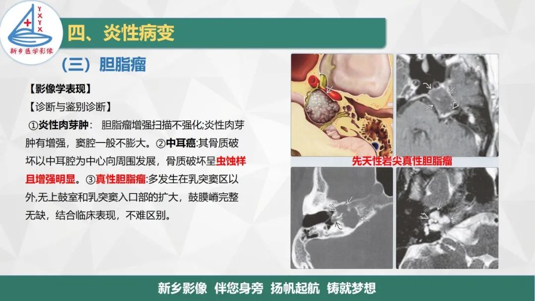 影像PPT - 【PPT】医学影像诊断学教材解读—耳部疾病-30
