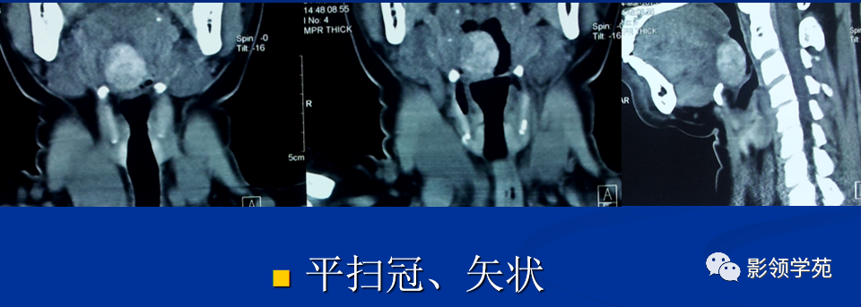 影像PPT - 异位甲状腺-2 影像PPT - 异位甲状腺-2