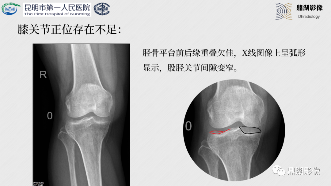 影像PPT - 【PPT】膝关节X线摄片技术改进-7