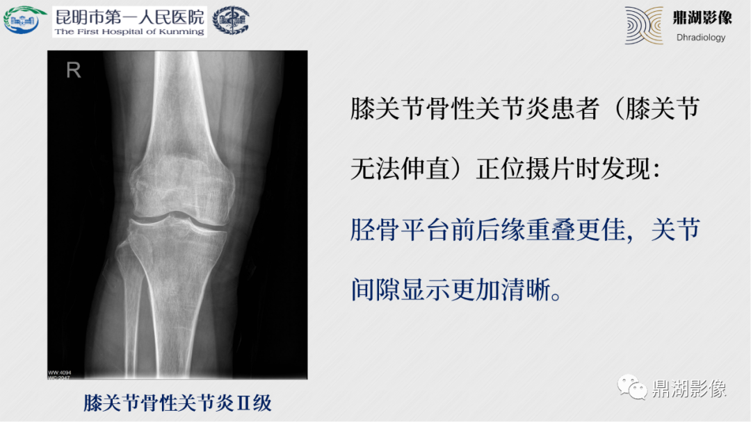 影像PPT - 【PPT】膝关节X线摄片技术改进-12