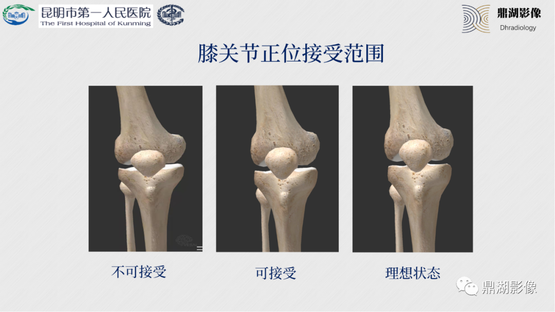 影像PPT - 【PPT】膝关节X线摄片技术改进-13