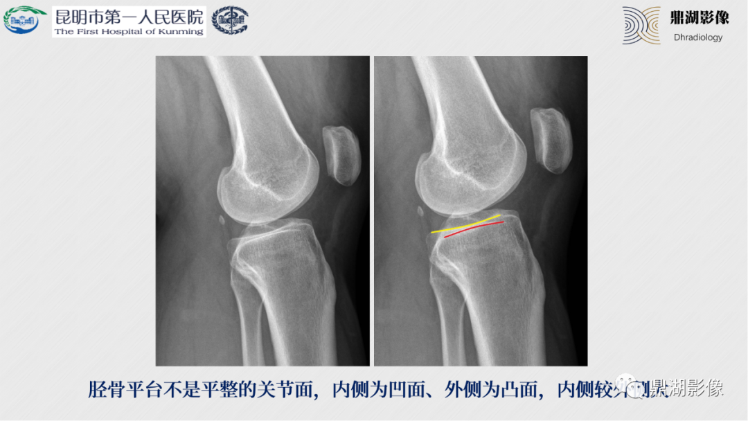 影像PPT - 【PPT】膝关节X线摄片技术改进-15