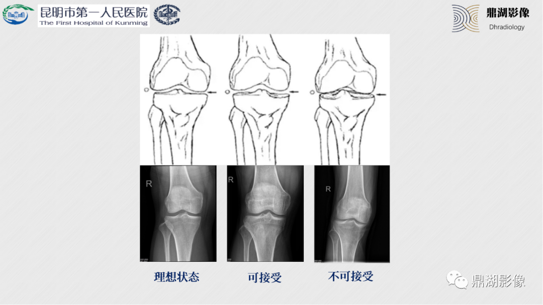 影像PPT - 【PPT】膝关节X线摄片技术改进-14