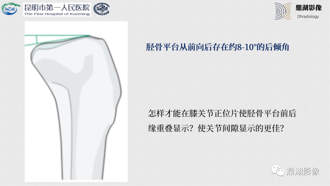 影像PPT - 【PPT】膝关节X线摄片技术改进-16