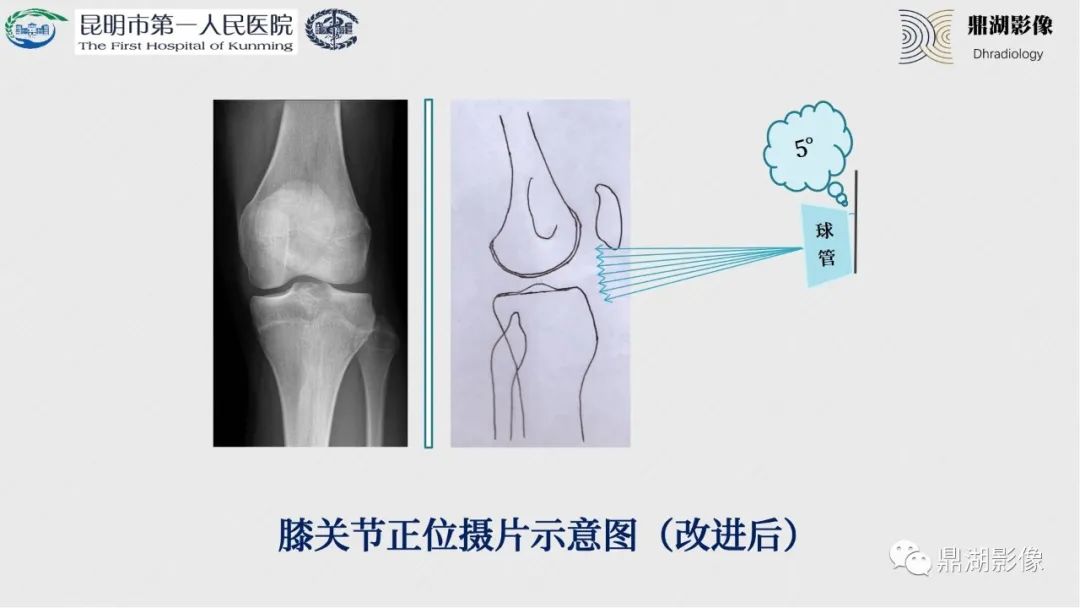 影像PPT - 【PPT】膝关节X线摄片技术改进-19