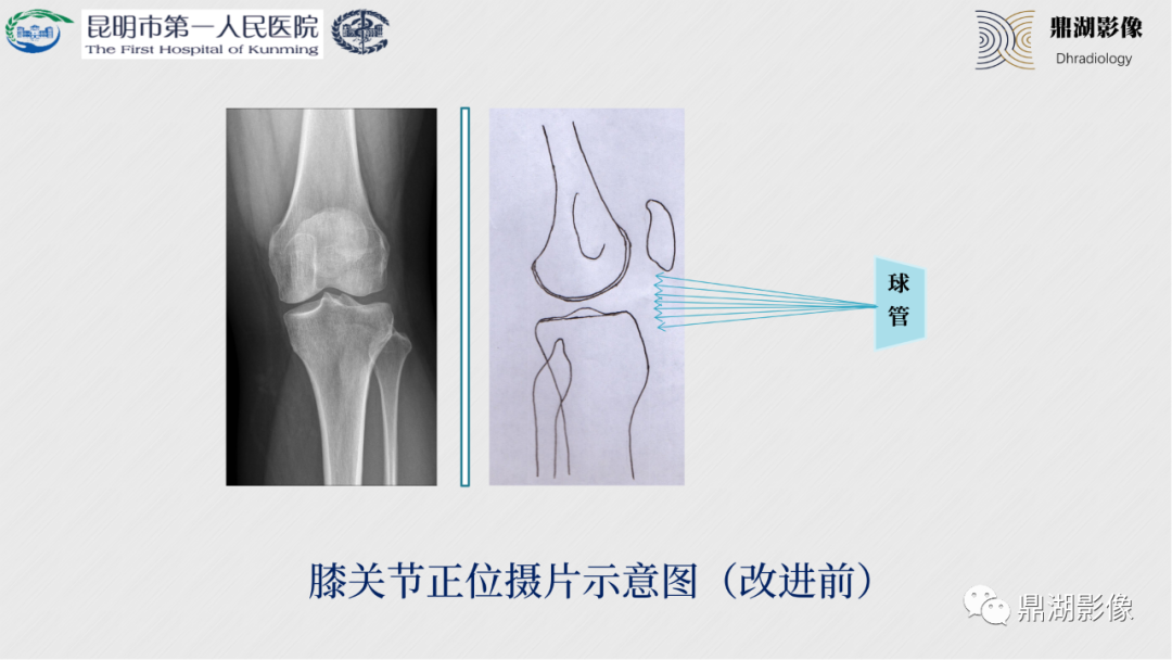 影像PPT - 【PPT】膝关节X线摄片技术改进-18