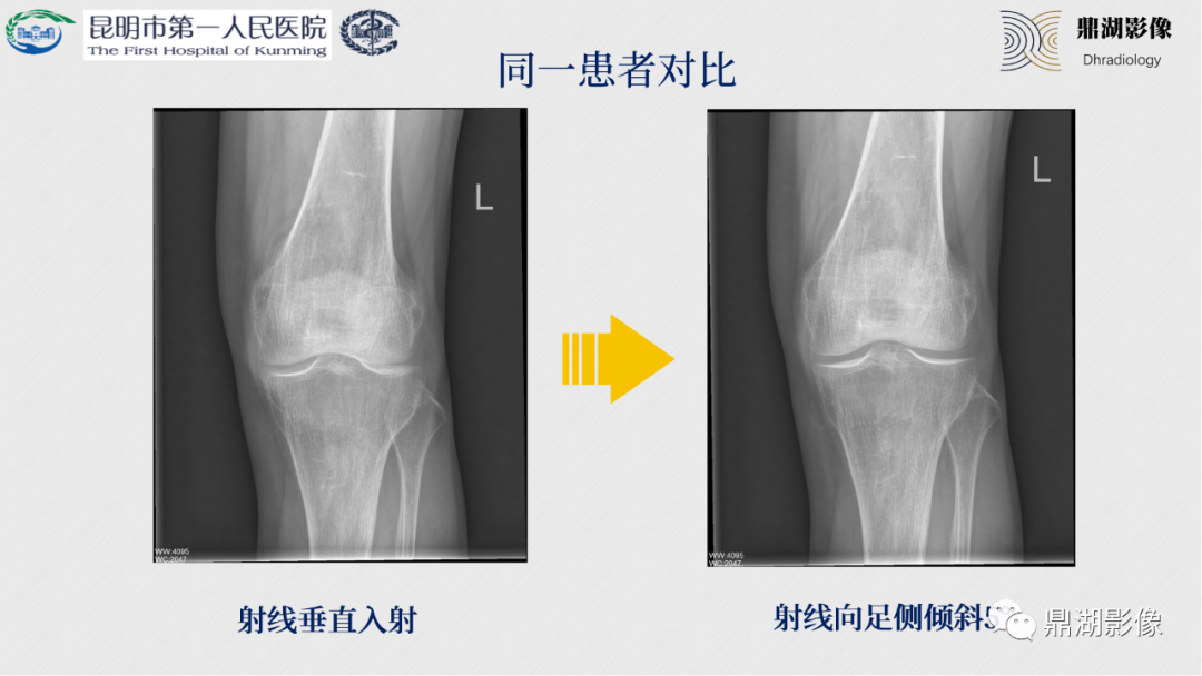 影像PPT - 【PPT】膝关节X线摄片技术改进-21