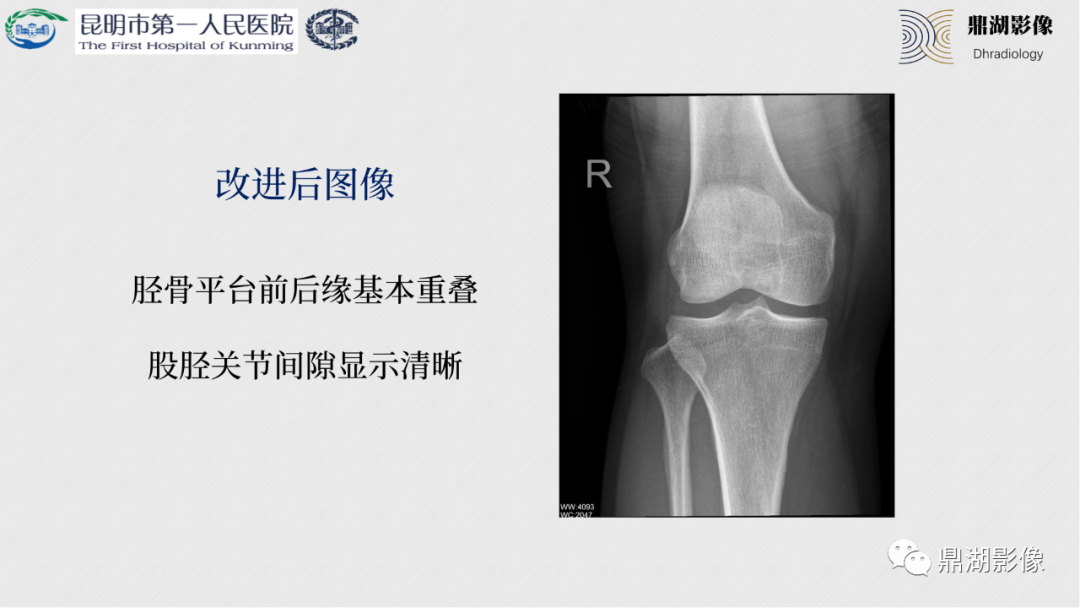 影像PPT - 【PPT】膝关节X线摄片技术改进-22