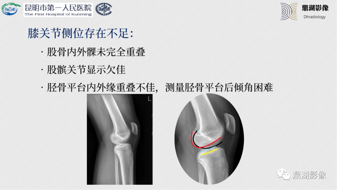 影像PPT - 【PPT】膝关节X线摄片技术改进-28