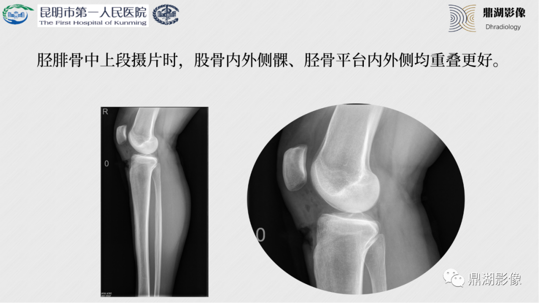 影像PPT - 【PPT】膝关节X线摄片技术改进-33