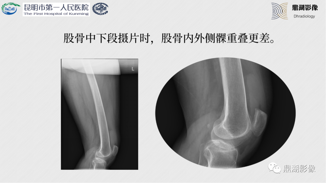 影像PPT - 【PPT】膝关节X线摄片技术改进-34