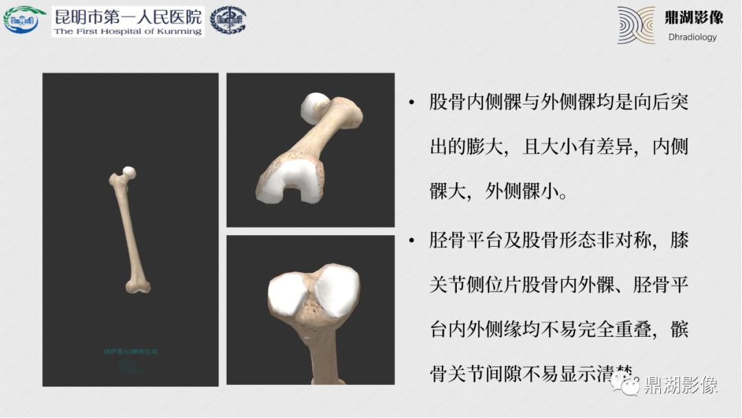 影像PPT - 【PPT】膝关节X线摄片技术改进-35