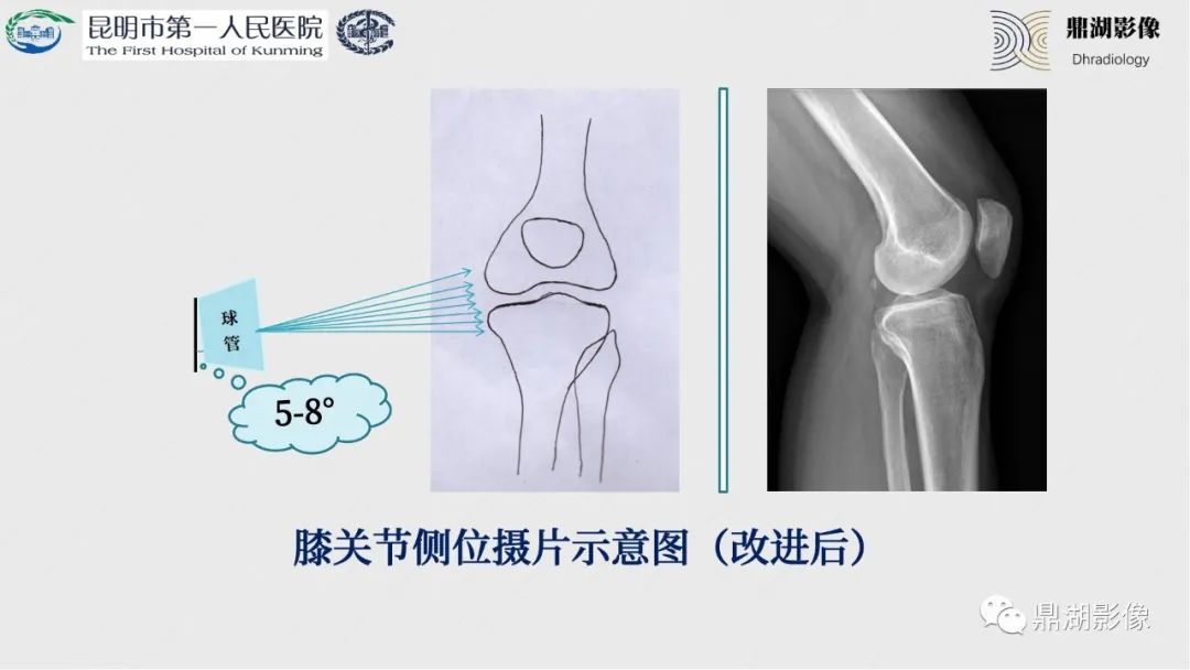 影像PPT - 【PPT】膝关节X线摄片技术改进-38