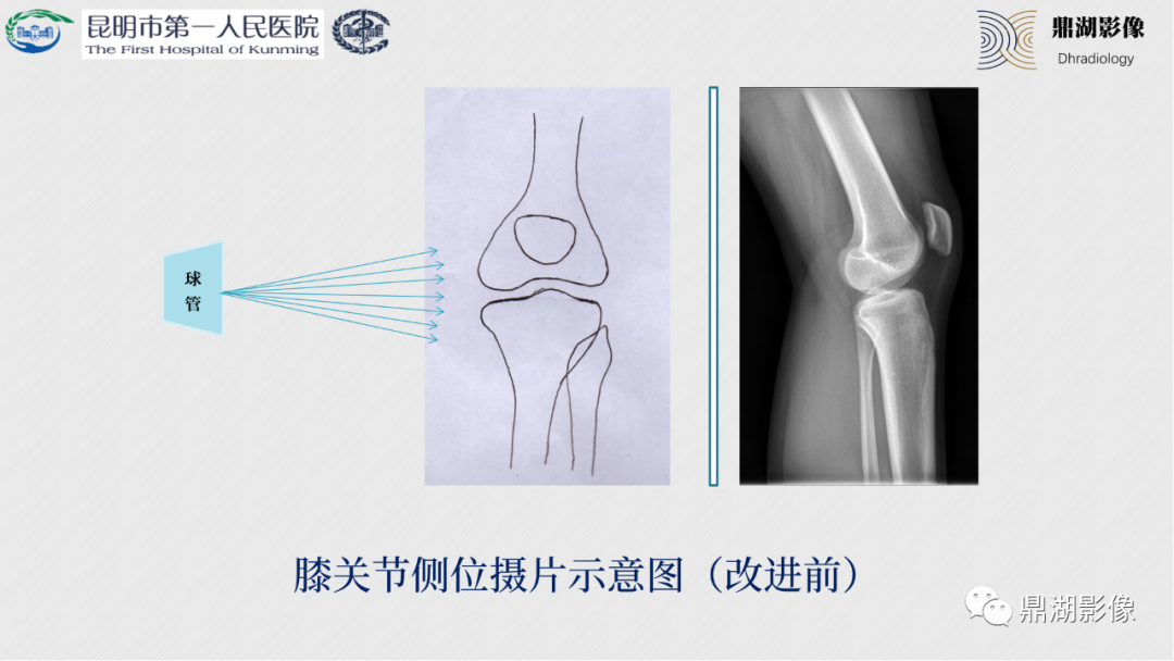 影像PPT - 【PPT】膝关节X线摄片技术改进-37